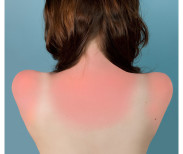 Brea Souders, Sunburn in Naples, 2010. Image courtesy of Daniel Cooney Fine Art