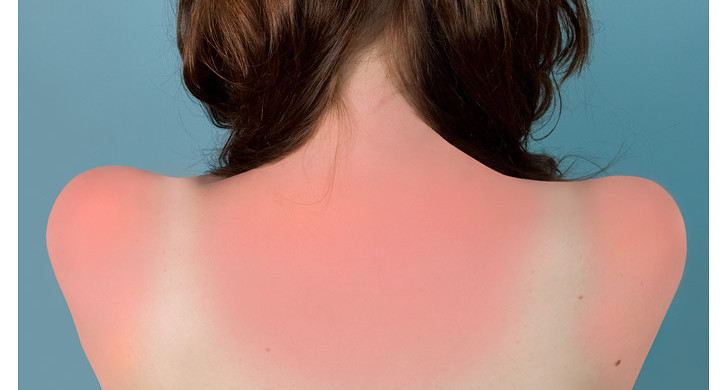 Brea Souders, Sunburn in Naples, 2010. Image courtesy of Daniel Cooney Fine Art